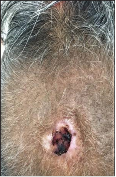 Scalp lesion recurrence 4 months post-radiation.